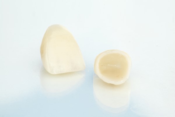 Dental Crowns Vs  Bridges: Important Differences To Keep In Mind