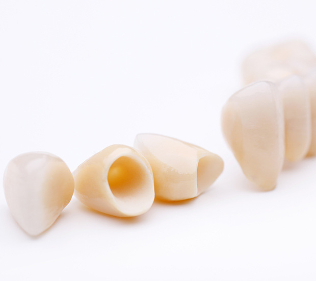 San Lorenzo Dental Crowns and Dental Bridges