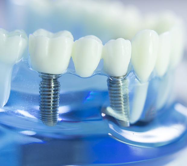 San Lorenzo Dental Implants