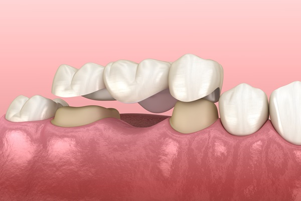 General Dentistry Restoration Options: Dental Bridge